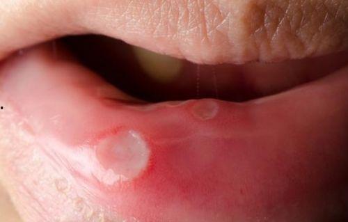 口腔癌的网红医生,口腔癌的防治之道